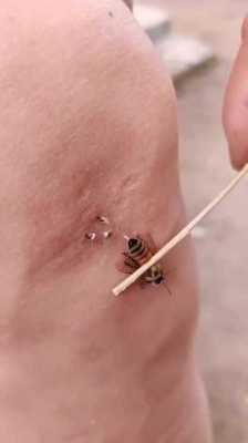  蜜蜂针毒有什么用v「蜜蜂毒针留在皮肤内会怎样」